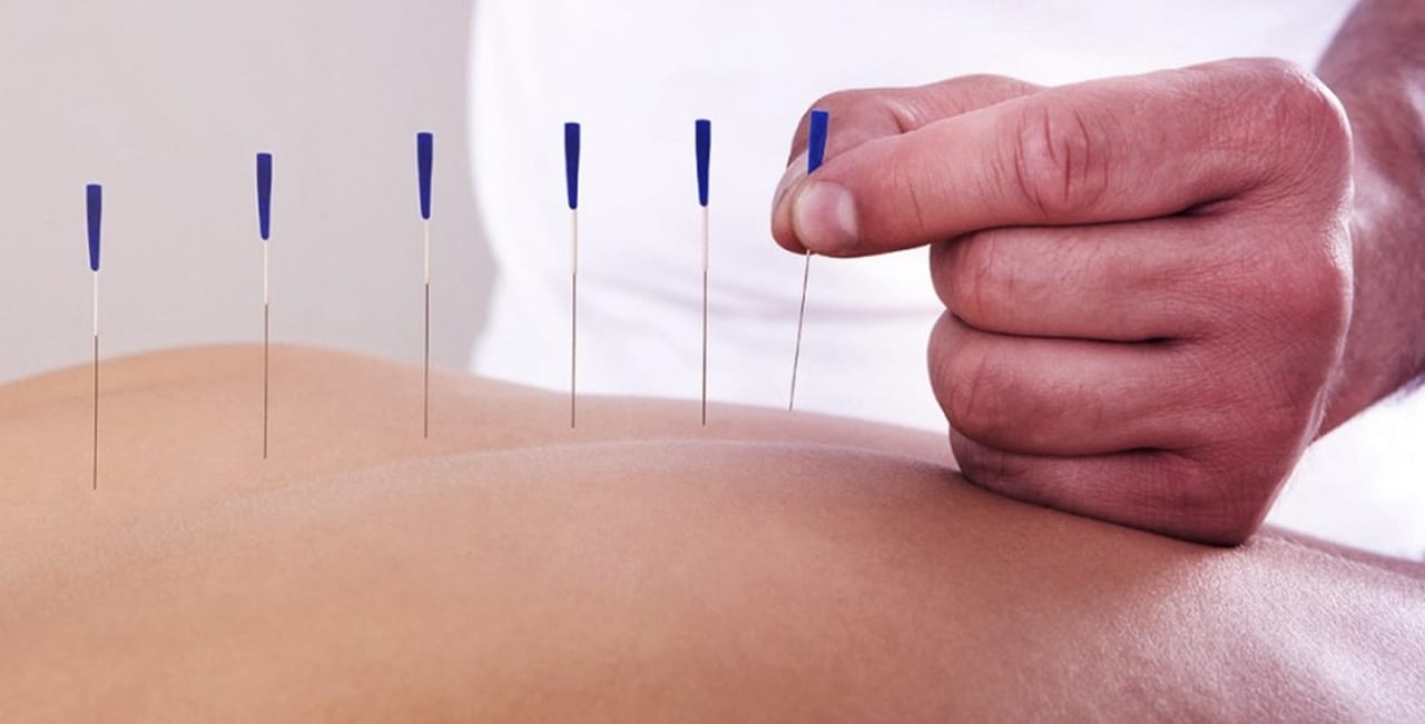 Vagas abertas para curso de Dry Needling em Vitória