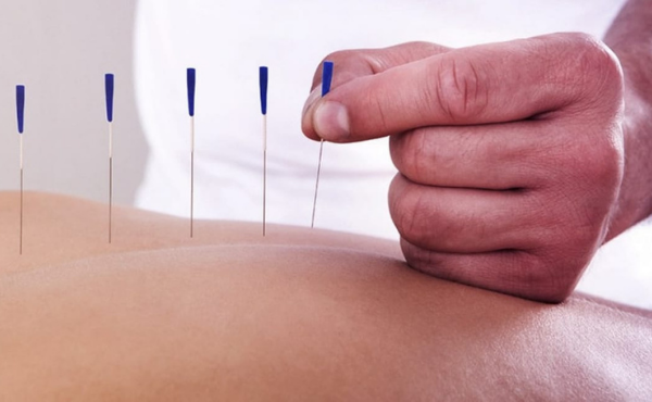 Dry Needling