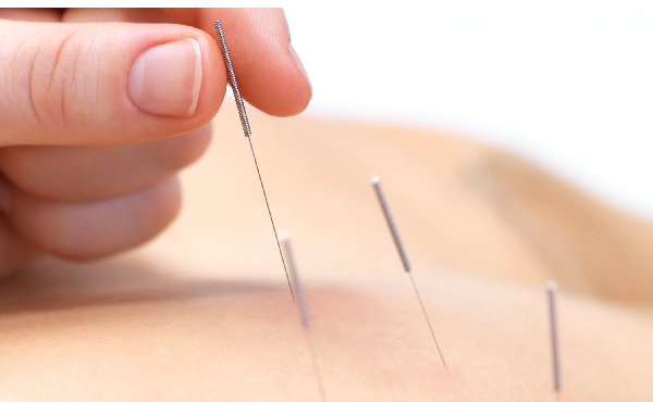 Curso Dry Needling e Auriculoterapia