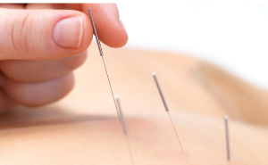 Curso Dry Needling e Auriculoterapia  
